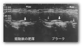 クレモト外科 頚動脈の肥厚とプラーク写真例
