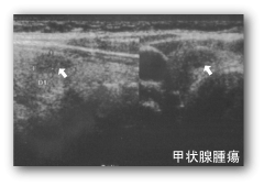 クレモト外科 甲状腺腫瘍写真例