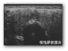 クレモト外科 慢性甲状腺写真例
