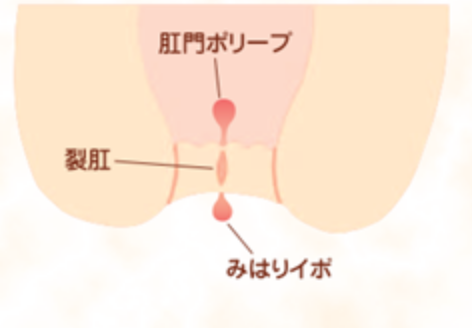 おしりの病気10