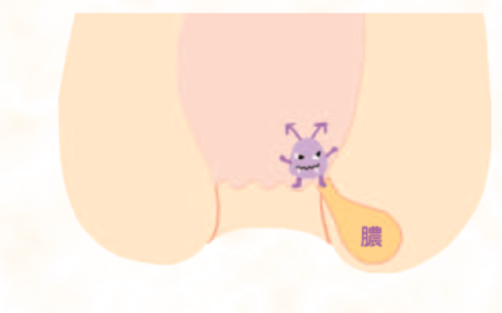 おしりの病気11