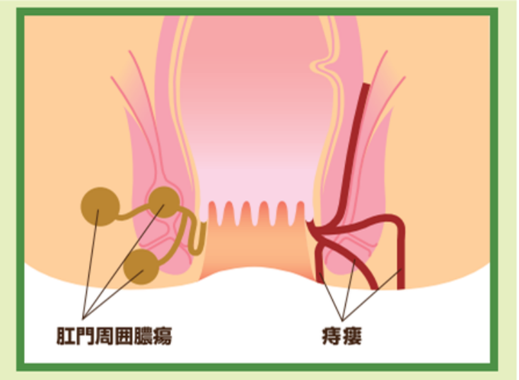 おしりの病気12