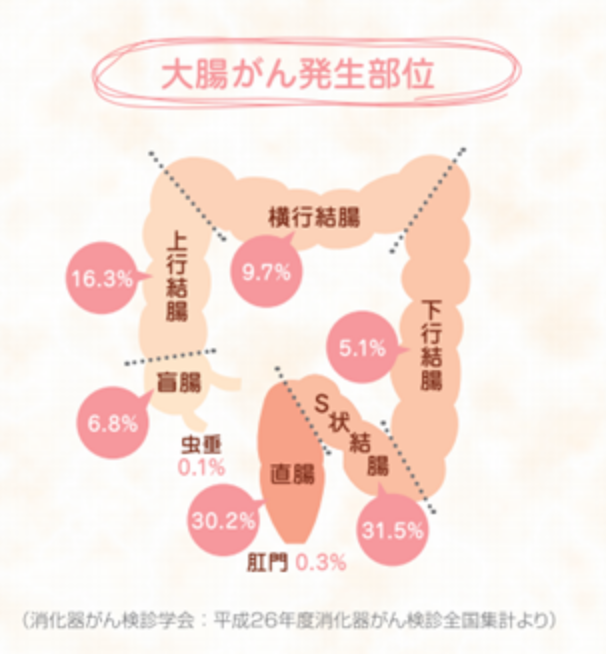 大腸がん発生部位
